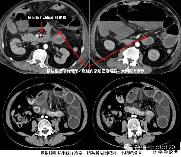 典型影像征象之---<font color="red">肠系膜</font>混浊征