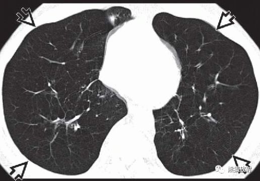 全小叶型/间隔旁型肺气肿丨CT诊断要点