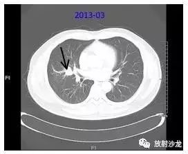 结肠癌肺转移MDT诊疗全程记录
