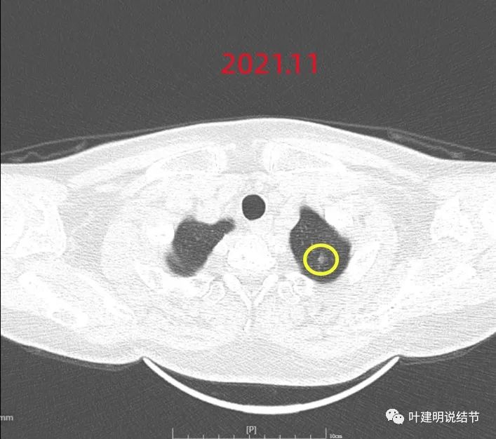 問診分析（2022.8.30）：兩肺多發(fā)結(jié)節(jié)考慮腫瘤性質(zhì)，還出現(xiàn)<font color="red">后背</font><font color="red">疼痛</font>，是危險的信號嗎？