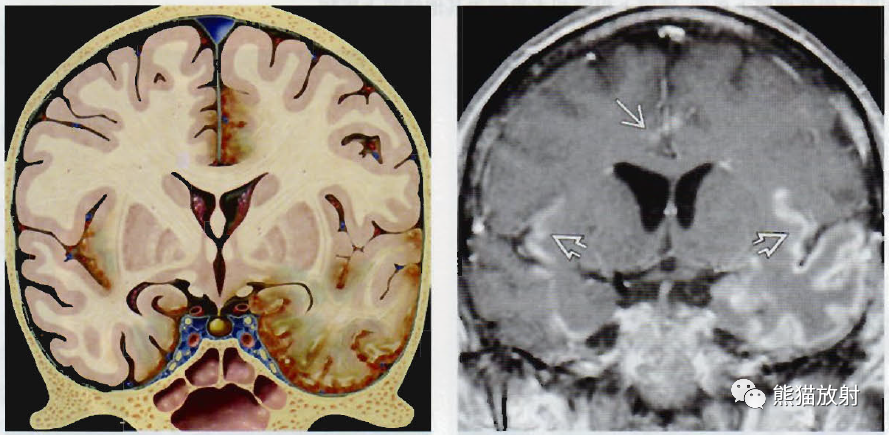 疱疹性脑炎、<font color="red">其他</font>各种脑炎丨影像诊断要点