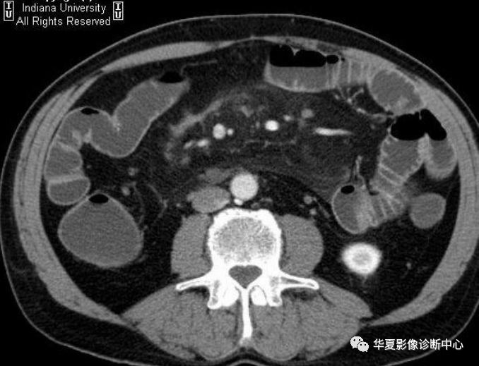 肠系膜脂膜炎影像诊断