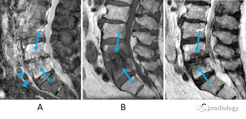 化脓性脊柱炎影像表现