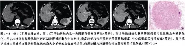 【PHILIPS每日一例】脾硬<font color="red">化性</font>血管瘤样结节性<font color="red">转化</font>的影像学表现2例