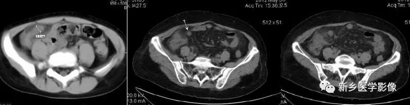 收藏！一文讀懂6種闌尾疾病的影像學(xué)