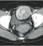 盆腔孤立纤维瘤一例