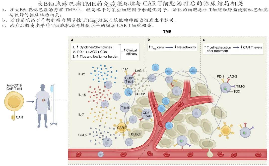 Nat Med：肿瘤免疫微环境在大B细胞淋巴瘤CAR T治疗中具有决定性作用