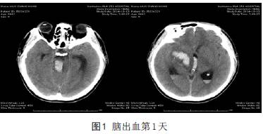 脑出血后脑死亡患者头颅CT影像学分析