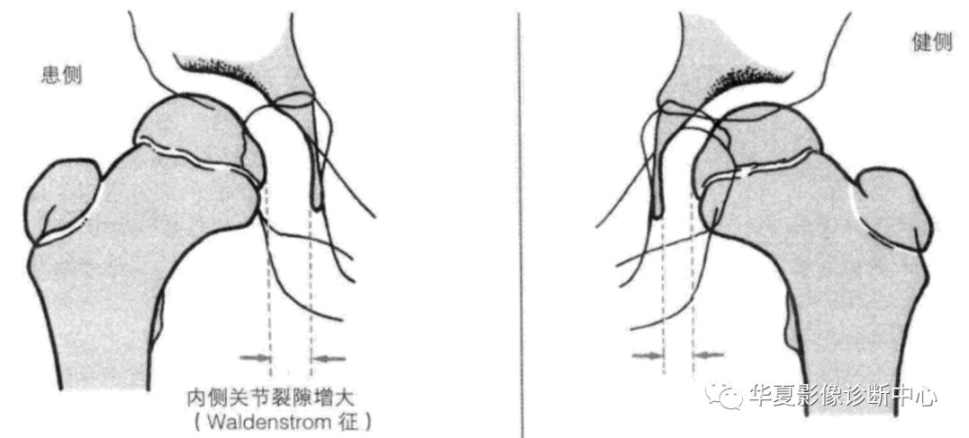 【影像基础】股骨头骨<font color="red">骺</font>缺血性坏死