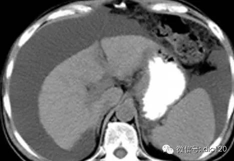肝硬化CT病例图片影像诊断分析