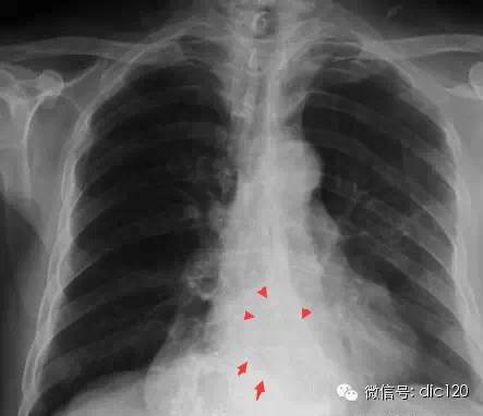 食管裂孔疝--X线胸片病例及相关知识