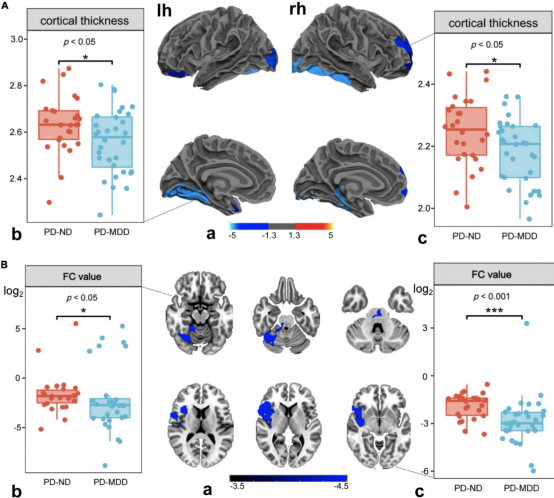Front.aging neurosci：帕金森病抑郁表型可能与不正常的皮质<font color="red">萎缩</font>和功能连接有关