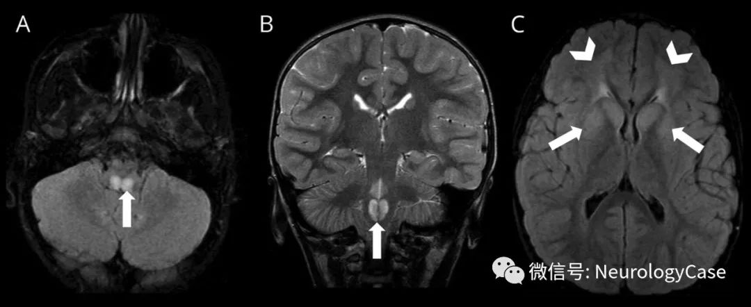 Neurology：1例青少年起病的亚历山大病的延髓背侧病变