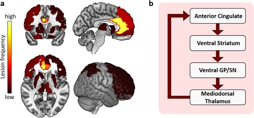 Mol Neurodegener综述：阿尔兹<font color="red">海</font>默症精神症状的脑影像机制