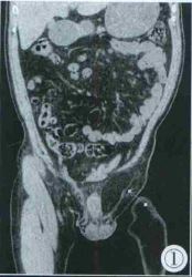 【每日一例】术前CT诊断精索脂肪瘤1例