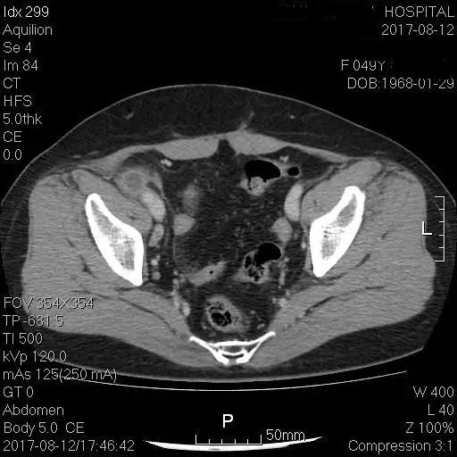阑尾炎的诊断，需不需要CT证实？