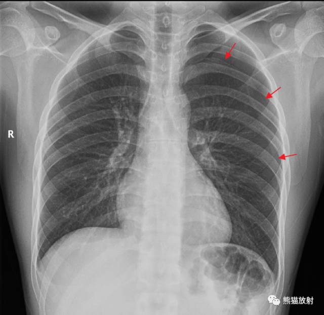 <font color="red">气胸</font>时如何大体判断肺被压迫的程度？