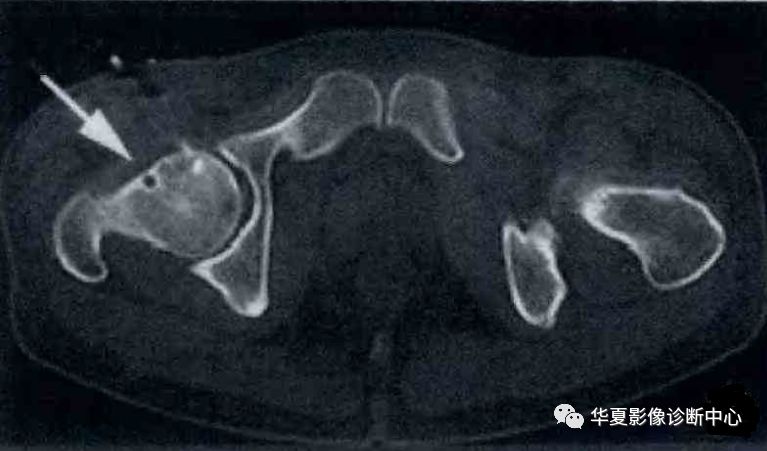 【影像基础】股骨颈滑膜疝的影像诊断
