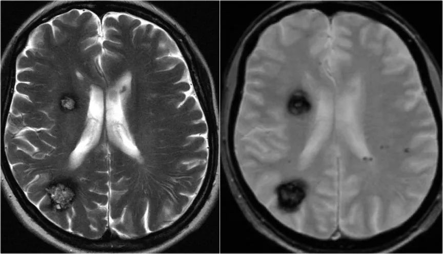 脑癫痫：MRI的作用（三）<font color="red">海绵状</font><font color="red">血管瘤</font>