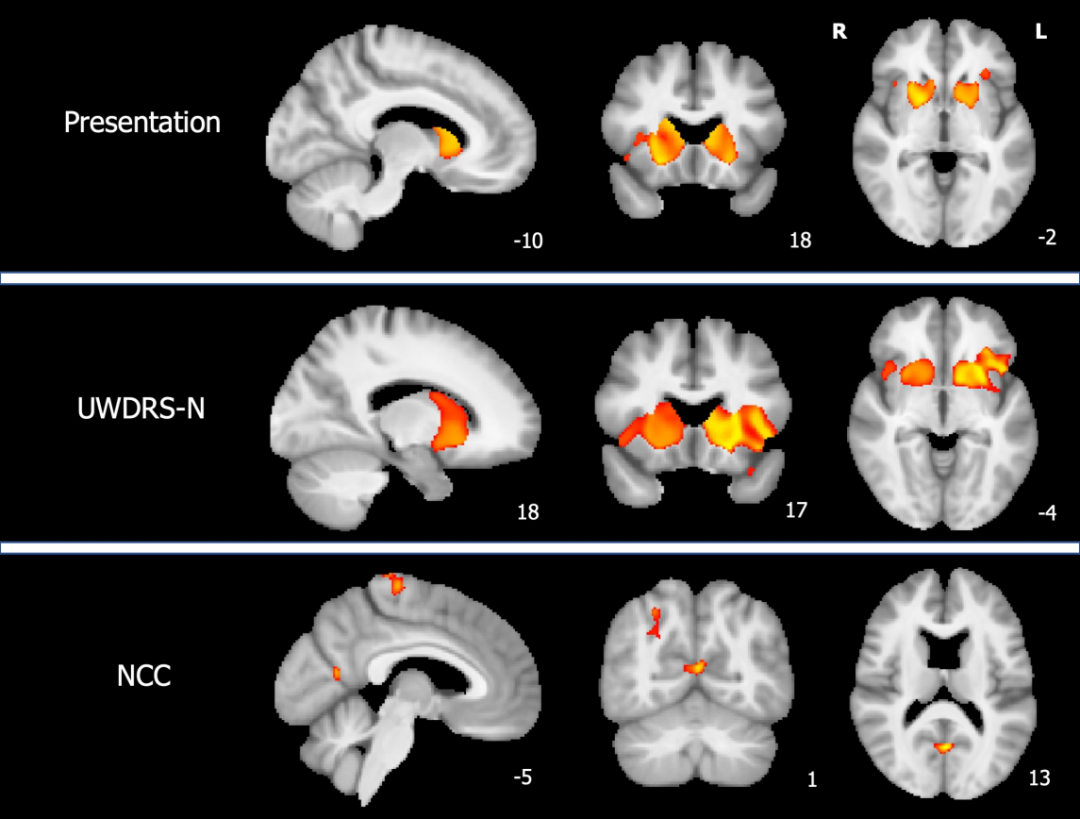 Brain：Wilson病脑<font color="red">损伤</font>的神经影像<font color="red">特征</font>—一项多模态全脑MRI研究