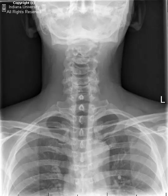 【每日一例319期】男性，颈部疼痛，曾有颈部手术史