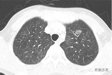 结节性硬化性综合症之多灶性微小结节样肺细胞增生（MMPH）一例
