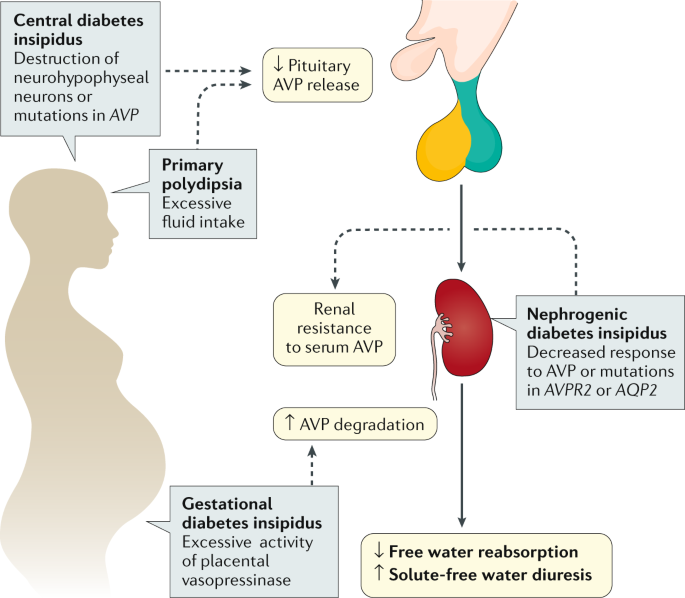 Diabetes insipidus | Nature Reviews Disease Primers