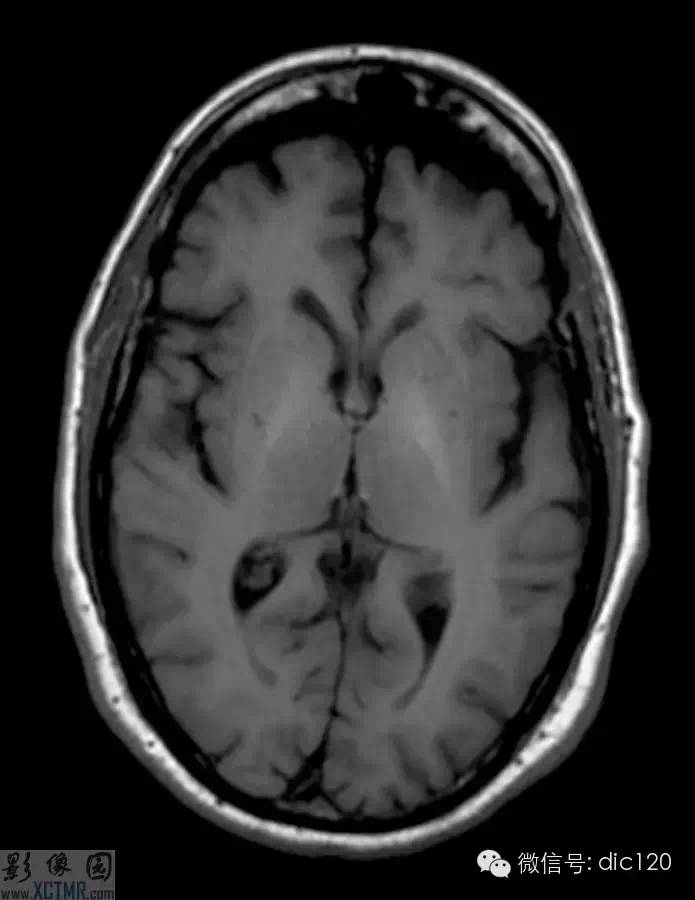 【经典病例解析】慢性肝性脑病(Chronic hepatic encephalopathy)MRI病例图片影像诊断分析