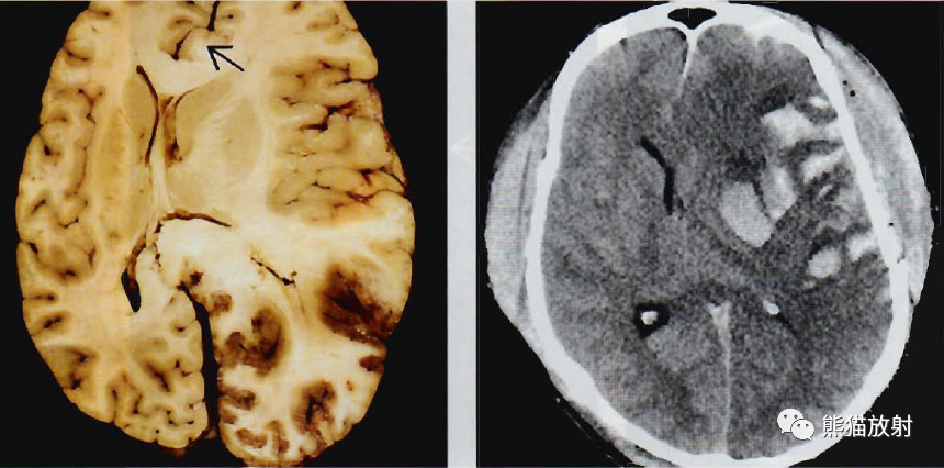 脑疝、脑死亡——影像诊断详细篇！