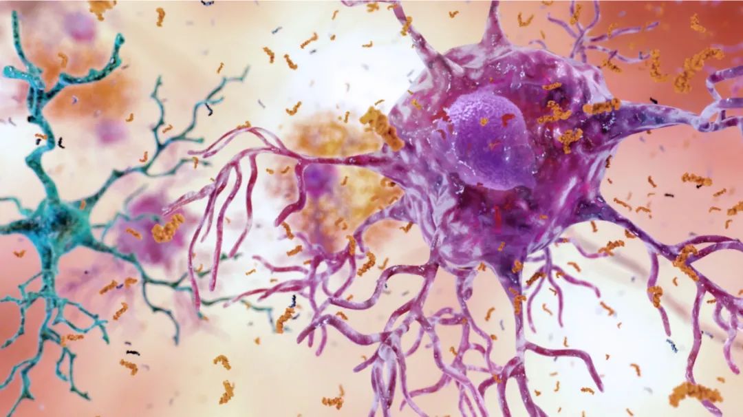 新理论认为，阿尔茨海默病本质上并非大脑疾病，而是自身免疫疾病