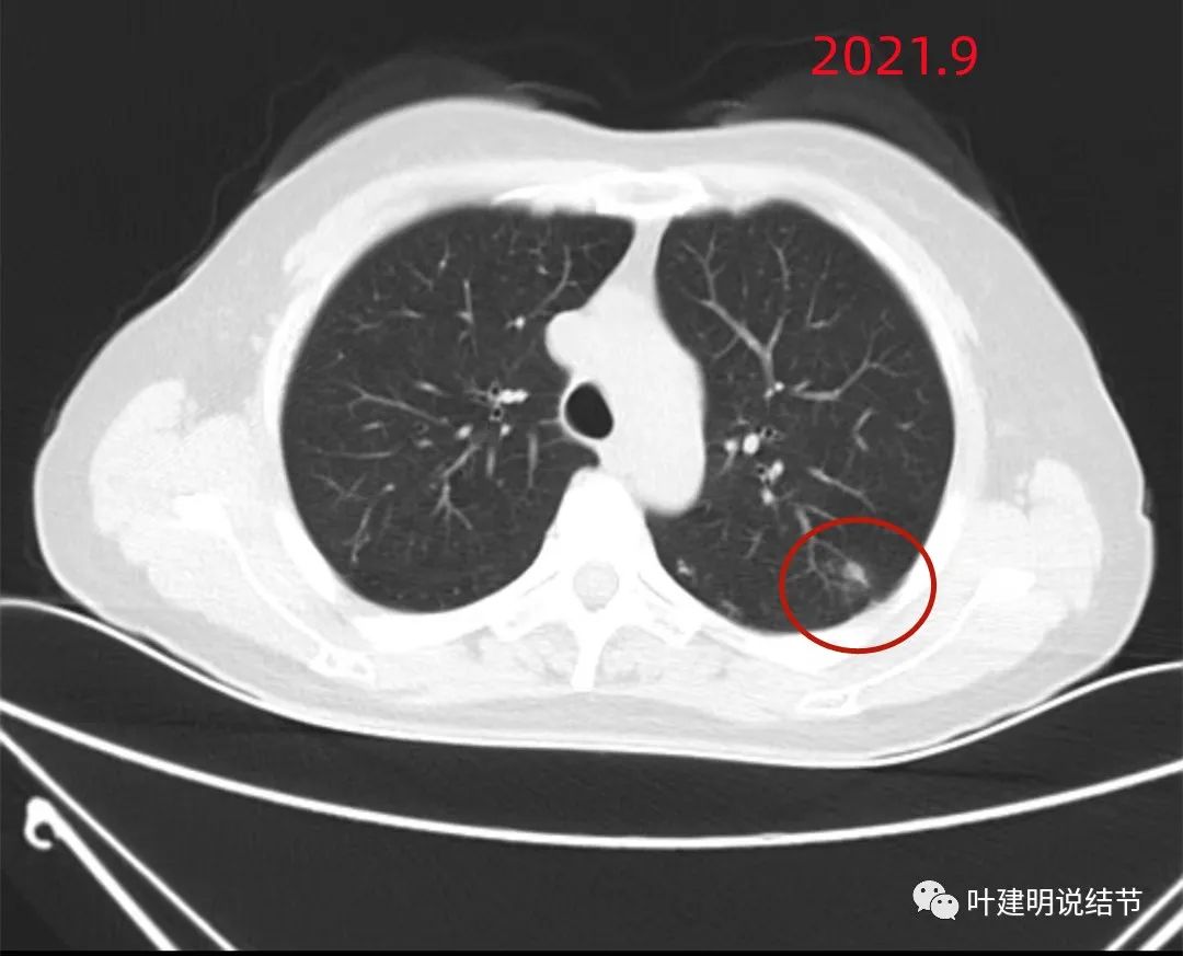 误诊分析（2022.9.5）：随访进展还<font color="red">伴</font>胸膜牵拉的肺结节为什么不是恶性？