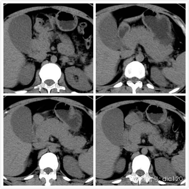 华夏病例--水肿型急性胰腺炎MRI、CT影像表现