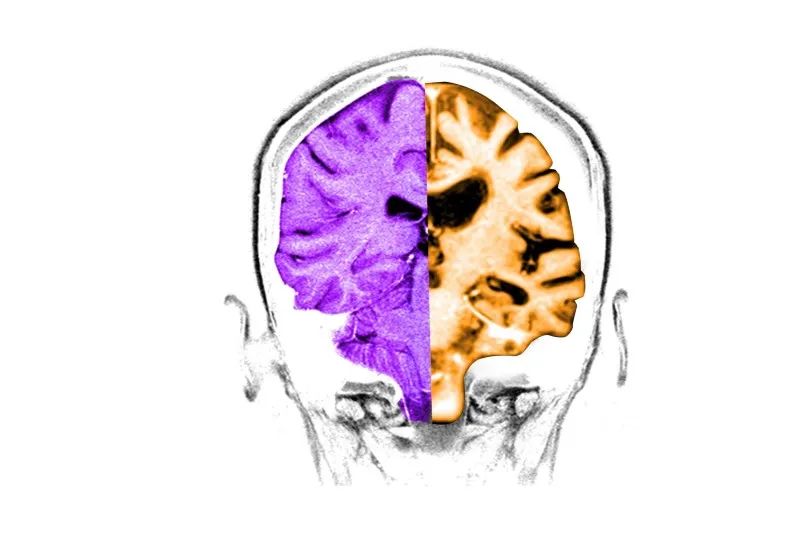 罕见的脑炎症可能为治疗阿尔茨海默病提供了线索