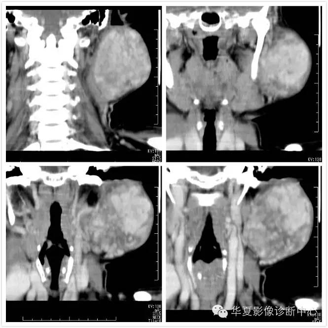 腮腺混合瘤--CT病例图片影像诊断分析