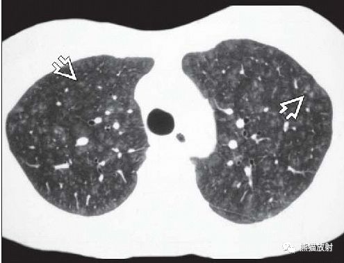呼吸性细支气管炎丨CT表现、诊断要点