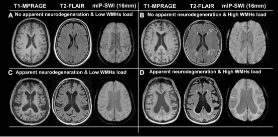 MRI显示白质静脉密度降低与老年人的神经<font color="red">退行性</font><font color="red">变</font>和认知障碍有关