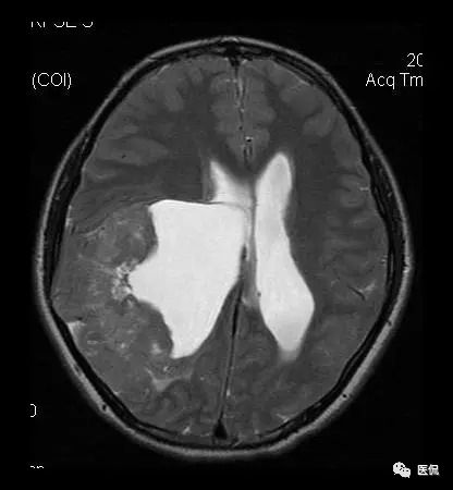 头痛半年，典型的胶质母细胞瘤MR病例影像诊断分析