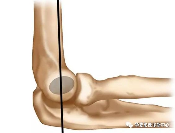 【影像基础】肱骨髁上骨折 Gartland 分型