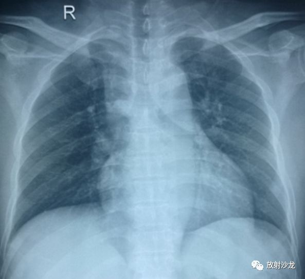 呼吸经典病例：急性肺<font color="red">血栓</font>栓塞症