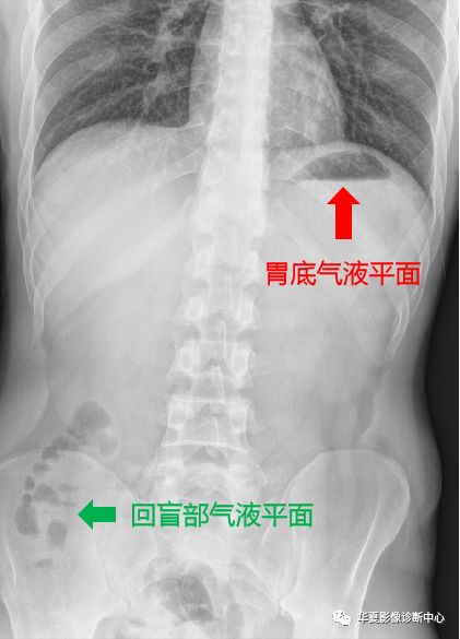 肠梗阻X线表现