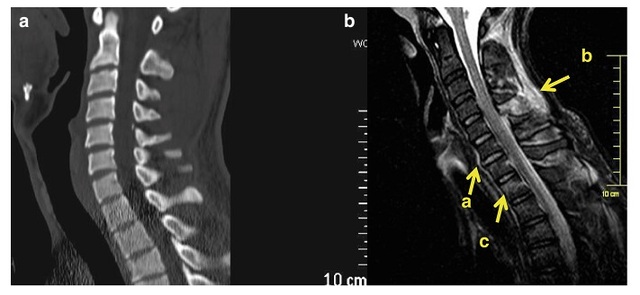 MRI 评估急性脊髓创伤软组织和硬膜囊内损伤方面优于 <font color="red">CT</font>