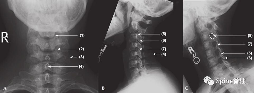 推薦收藏！頸椎X線片能給我們診斷帶來那些提示呢？