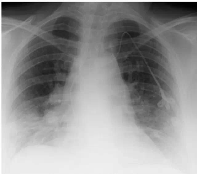【PHILIPS每日一例】多肺叶密集结节伴大量咳血的罕见病例报告