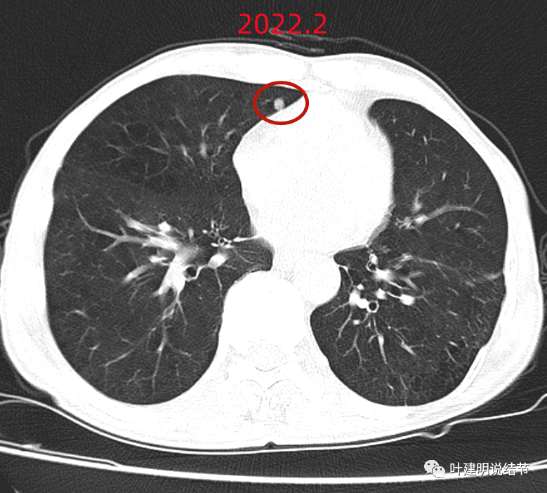 问诊分析（2022.9.6）：判断肺结节良恶性，最重要、最该注意的是什么？