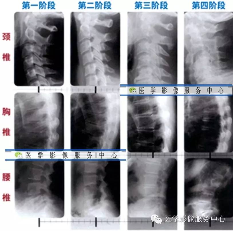 颈胸腰椎退变的四阶段影像表现