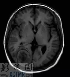 【每日一例 | 368期】右侧枕部显著强化病变MRI病例
