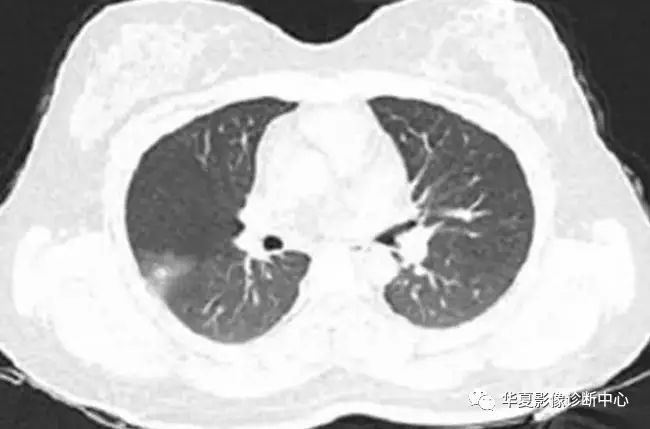 【影像视界】肺部子宫内膜异位症