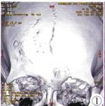 颅骨骨膜窦合并颅内海绵状血管瘤及额中缝1例