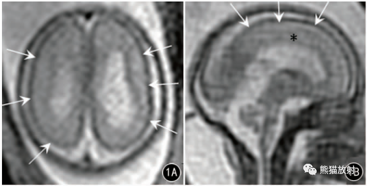 胎儿大脑皮质发育畸形丨产前<font color="red">MRI</font>诊断