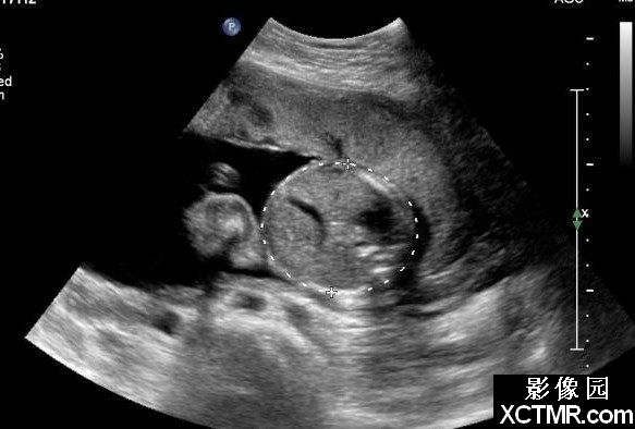 胎儿正常超声表现(<font color="red">妊娠</font>各期精彩图文)